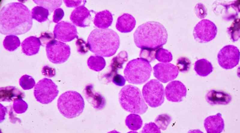 Повышенные лимфоциты в крови у женщин